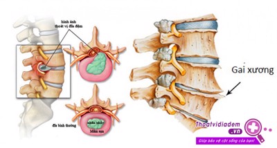 Bị thoát vị đĩa đệm – Dùng ngay Cốt Thoái Vương 