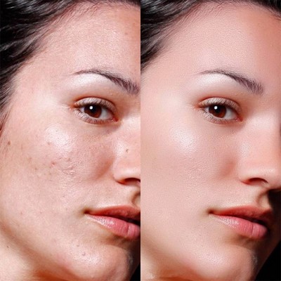 Dùng thuốc điều trị và chăm sóc da đúng cách có ý nghĩa như thế nào trong việc phục hồi da sau mụn?