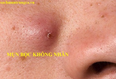 Mụn bọc không nhân là gì? Làm sao để điều trị hiệu quả?