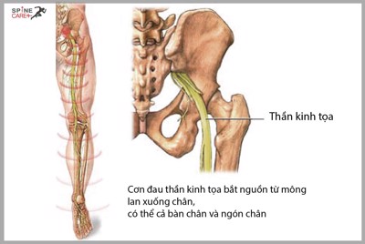 Tình trạng đau dây thần kinh tọa ở phụ nữ đang mang thai có nguy hiểm không?