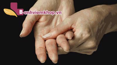 Viêm khớp là gì? Tại sao nên sử dụng Hoàng Thấp Linh hỗ trợ điều trị?