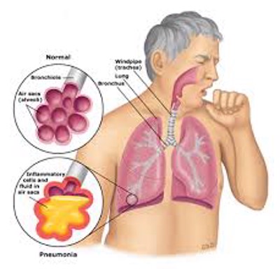 Biến chứng của viêm phổi có thể gặp phải là gì? XEM NGAY!