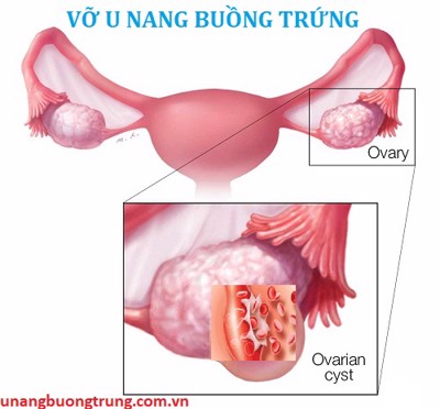 Vỡ u nang buồng trứng và những hệ lụy mà bạn chưa biết