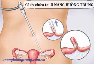 Các cách chữa trị u nang buồng trứng và giải pháp hay từ sản phẩm thảo dược Nga Phụ Khang