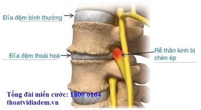 Thoái hóa đĩa đệm nguy hiểm như thế nào?