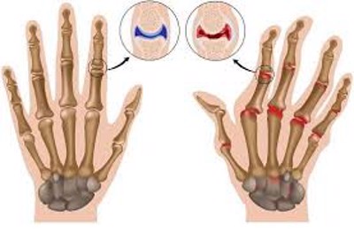 Người bị viêm đa khớp dạng thấp nên có chế độ sinh hoạt, vận động như thế nào?