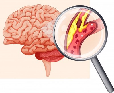 Sản phẩm nào hỗ trợ phòng ngừa cục máu đông hiệu quả hiện nay?