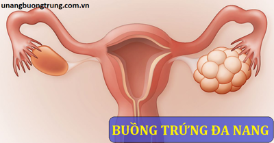 Buồng trứng đa nang là gì và ý nghĩa của hình ảnh buồng trứng đa nang trên siêu âm