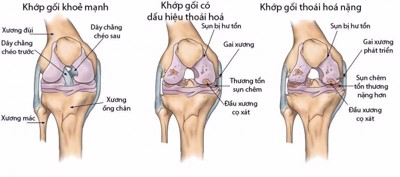 Thoái hóa khớp dễ gặp ở những vị trí nào nhất? Chuyên gia Nguyễn Hồng Hải tư vấn