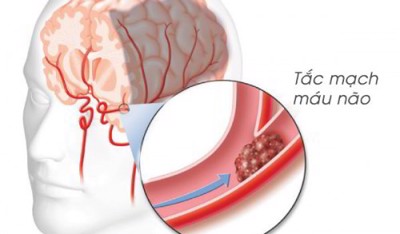 Trường hợp nào những cục máu đông trong não trở nên nguy hiểm?