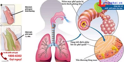 Bị viêm phế quản phổi có nguy hiểm không? Làm sao để cải thiện tình trạng bệnh?