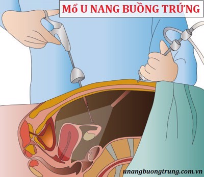 Mổ u nang buồng trứng và một số câu hỏi thường gặp có thể bạn chưa biết