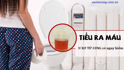 Chứng minh: U XƠ TỬ CUNG có nguy hiểm qua TOP 5 biến chứng thường gặp này!