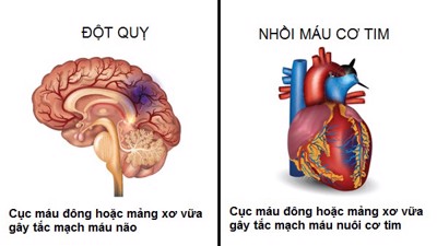 Đột quỵ não và nhồi máu cơ tim khác nhau như thế nào?