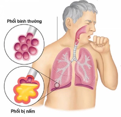 Hoạt chất mới Fibrolysin giúp cải thiện bệnh viêm phổi hiệu quả