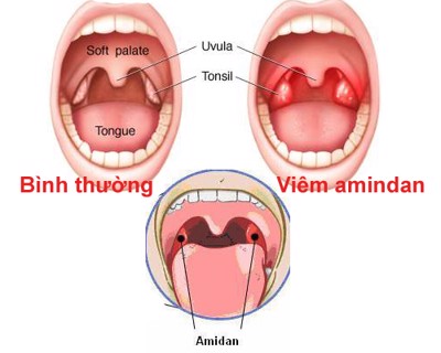 Tiêu chí chỉ định cắt amidan là gì và có những phương pháp nào?