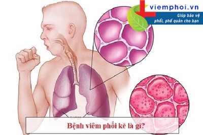 Ho, khó thở, mệt mỏi do bệnh viêm phổi kẽ phải làm sao?