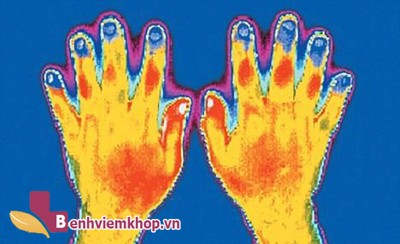  Bệnh VIÊM KHỚP TAY và cách hỗ trợ điều trị hiệu quả, an toàn