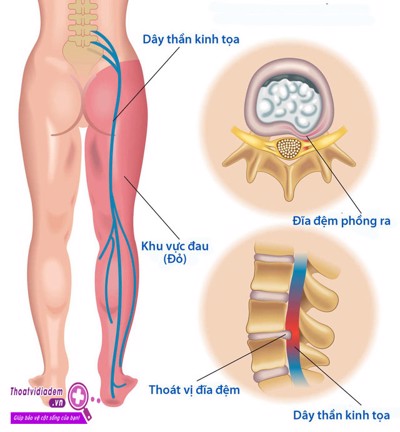 Đau dây thần kinh tọa ở chân có phải là hậu quả của thoái hóa cột sống thắt lưng không?   