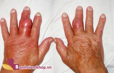 Ngón tay bị sưng đỏ đau nhức là dấu hiệu của bệnh gì? Xem ngay để biết!