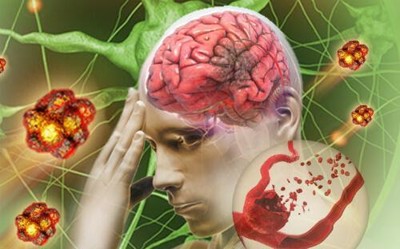Nhanh chóng nhận biết những biểu hiện tai biến mạch máu não qua từng giai đoạn!