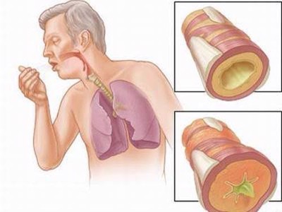 Viêm phế quản cấp tính là gì? Do các nguyên nhân nào gây nên? Phòng ngừa và điều trị bằng cách nào?