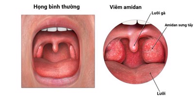 Viêm amidan là gì? Biểu hiện như thế nào? Những đối tượng nào dễ mắc phải?