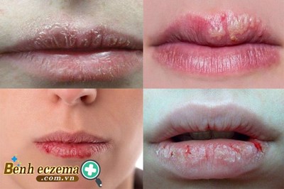 7 lý do “không ngờ” khiến bệnh chàm môi ngày thêm trầm trọng