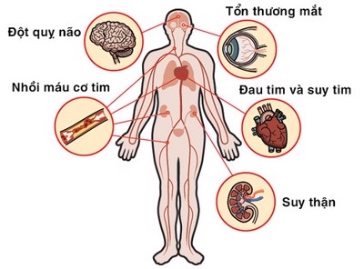 Những biến chứng cao huyết áp gây ra là gì? Bị huyết áp kèm theo đột quỵ nguy hiểm như thế nào?