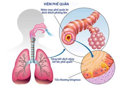 Dấu hiệu nhận biết viêm phế quản cấp tính và mạn tính là gì?