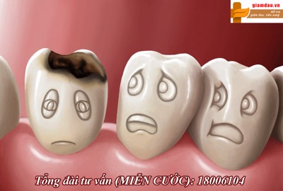 Một số thuốc giảm đau răng thường dùng. Tìm hiểu ngay!