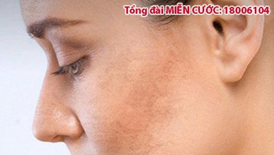 Nám da mặt – Nguyên nhân và cách cải thiện hiệu quả “mách nước” cho chị em