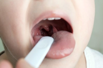 Nguyên nhân viêm loét họng ở trẻ, điều trị như nào hiệu quả