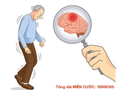 Những triệu chứng nhồi máu não nghe qua rất “vặt vãnh” nhưng nguy hiểm không tưởng