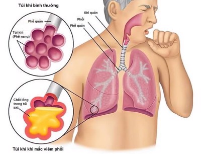 Bệnh viêm phổi có nguy hiểm không? Điều trị bao lâu thì khỏi?