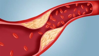 Rối loạn lipid máu có khác mỡ máu cao không? Bị mỡ máu cao nên ăn uống, sinh hoạt như thế nào?