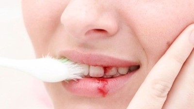 Chảy máu chân răng phải làm sao? Giải pháp của chuyên gia dành cho bạn