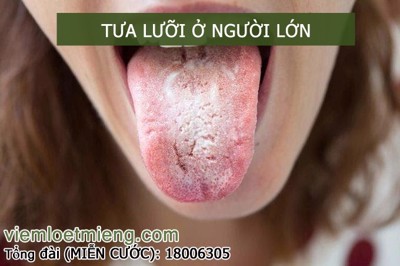 Gumimouth - Giải pháp cải thiện tình trạng tưa lưỡi ở người lớn an toàn, hiệu quả