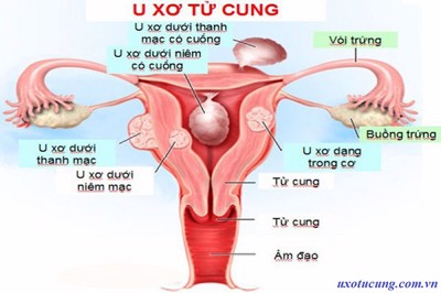  Ra máu sau khi mổ u xơ tử cung có phải bệnh tái phát không? 