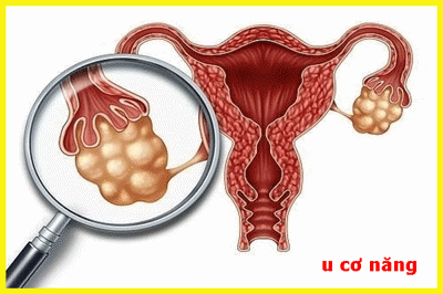 Nang cơ năng buồng trứng - Triệu chứng và cách điều trị bệnh hiệu quả