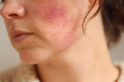 Bệnh viêm da tiếp xúc ở mặt và cách cải thiện hiệu quả, an toàn