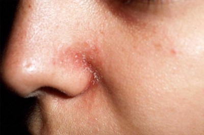 Xem ngay cách cải thiện ngứa ở mũi do bệnh viêm da tiết bã an toàn, hiệu quả