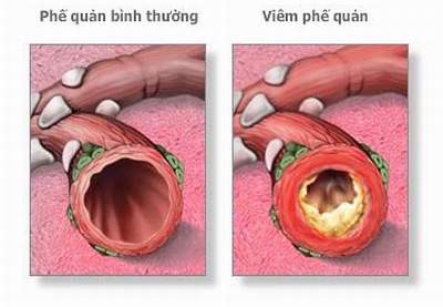 Viêm phế quản cấp tính là gì? Do các nguyên nhân nào gây nên? Phòng ngừa và điều trị bằng cách nào?