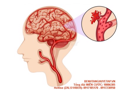 Nguyên nhân đứt mạch máu não là gì? Người bị đứt mạch máu não có dùng được Nattospes không?