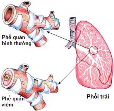 Viêm phế quản là gì? Có mấy dạng? Do nguyên nhân nào gây nên? 