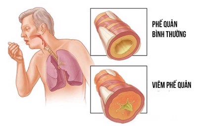 Những nguyên tắc cần tuân thủ trong điều trị viêm phế quản là gì?