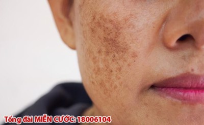 Dành cả thanh xuân để trị nám da mặt mà chưa biết đến silica thì quả là thiếu sót!