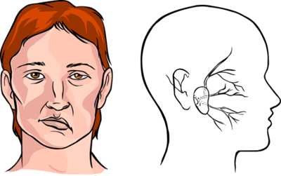 Từng bị liệt dây thần kinh số 7 ngoại biên và hay bị đau đầu, chóng mặt thì có nguy cơ đột quỵ không?