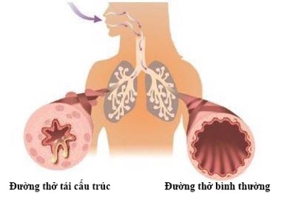 Viêm phổi và viêm phế quản phân biệt với nhau như thế nào?
