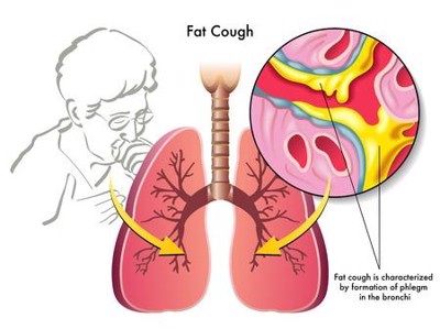 Bị ho có đờm do viêm phổi nên điều trị như thế nào? Dùng Bảo Phế Vương có tốt không?